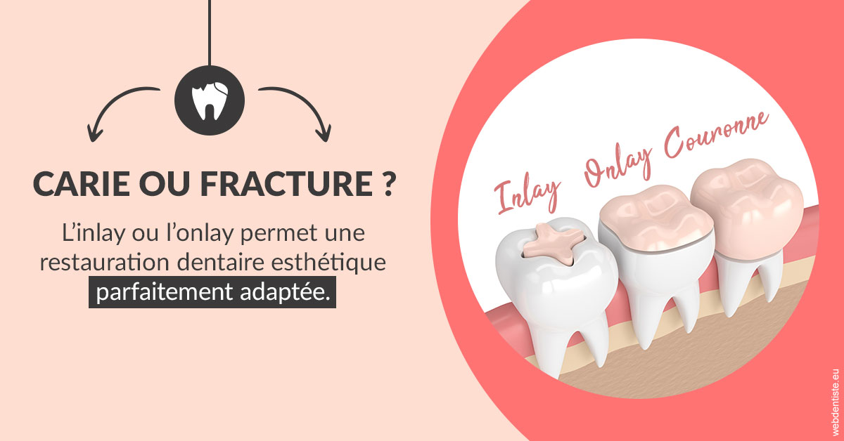 https://dr-pointeau-lafond-delphine.chirurgiens-dentistes.fr/T2 2023 - Carie ou fracture 2