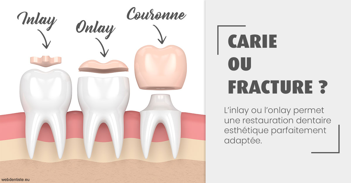 https://dr-pointeau-lafond-delphine.chirurgiens-dentistes.fr/T2 2023 - Carie ou fracture 1