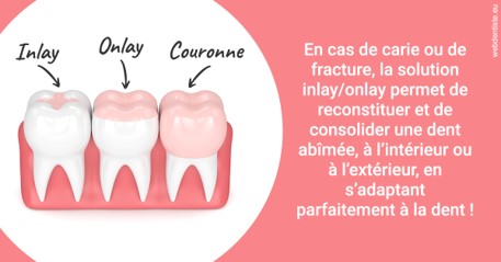 https://dr-pointeau-lafond-delphine.chirurgiens-dentistes.fr/L'INLAY ou l'ONLAY 2