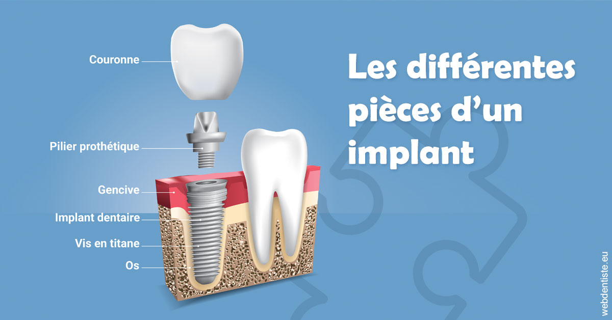 https://dr-pointeau-lafond-delphine.chirurgiens-dentistes.fr/Les différentes pièces d’un implant 1
