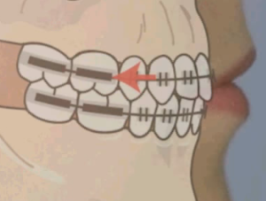 Traitements orthodonties 2